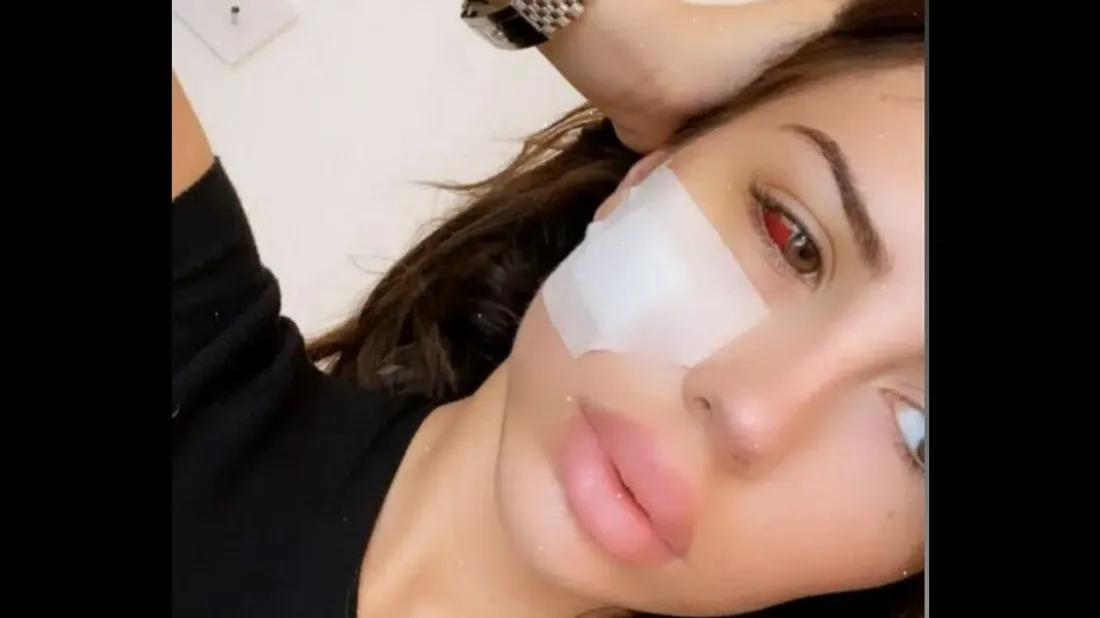 Dita Istrefi montre son visage après l’opération causée par son agression : 